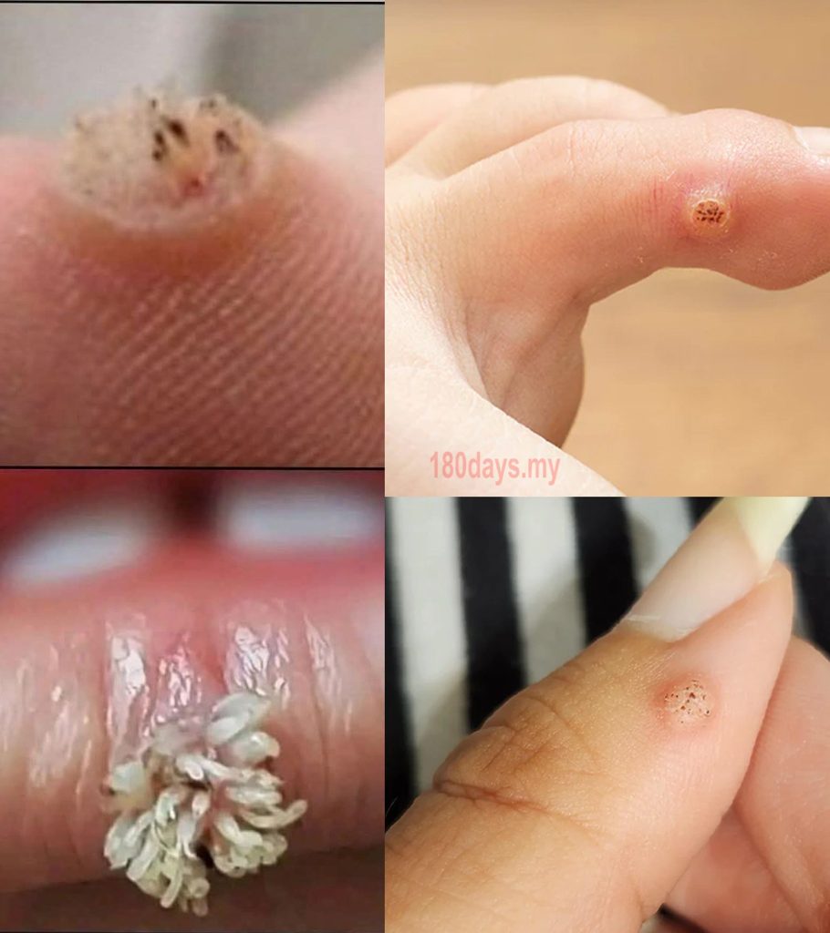 How to get rid of all Warts, Darkish Spots, Pimples, Pores, Skin Tags By Natural Remedies…