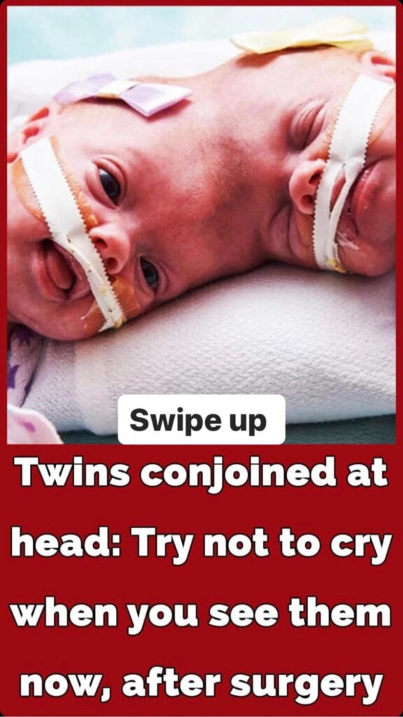 Conjoined twins Abby and Erin Delaney: Inside their remarkable story