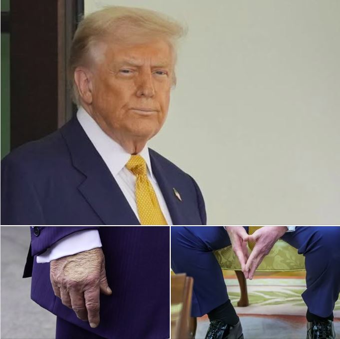 Trump Diagnosed with Common Vein Condition After Noticing Leg Swelling